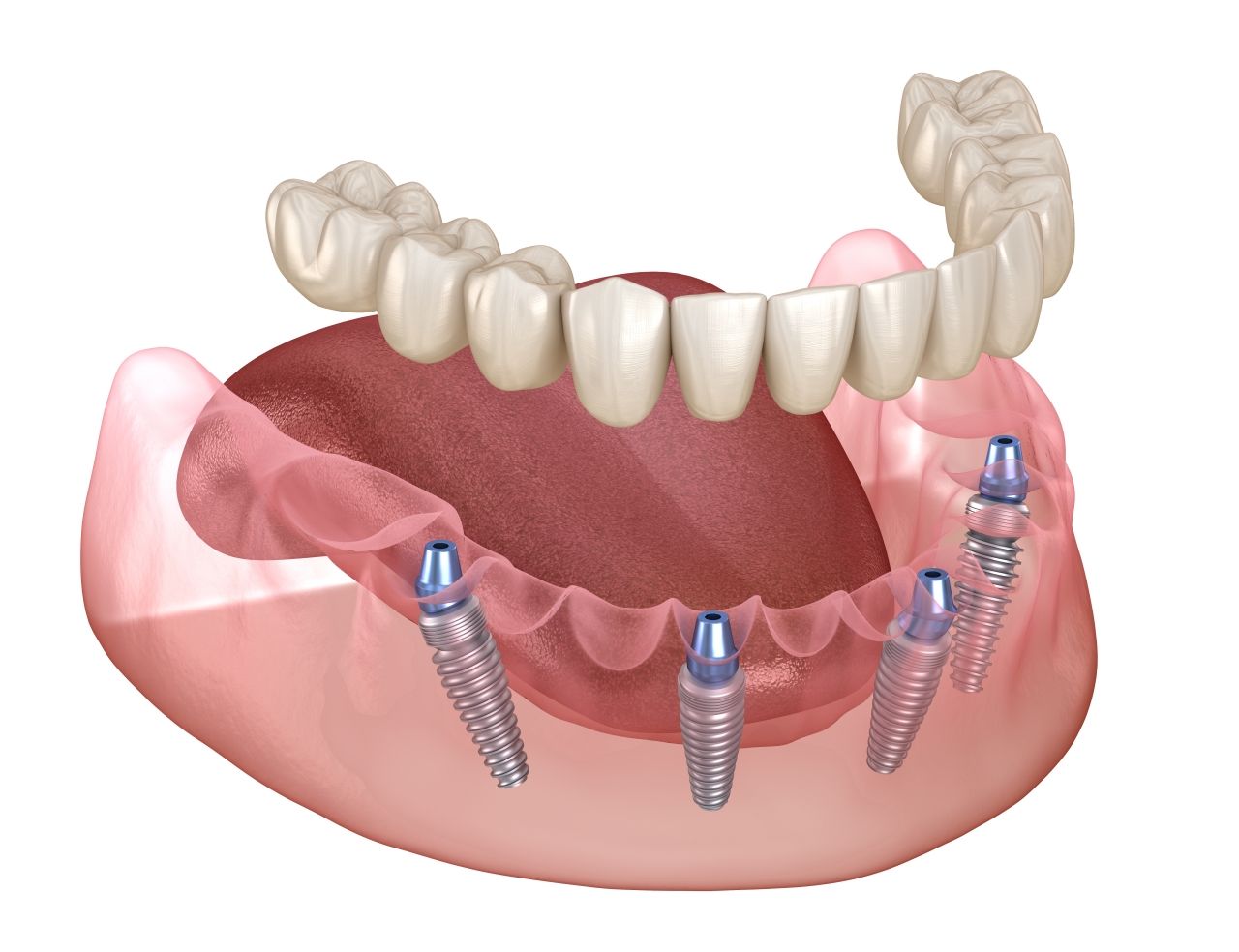 After an All-on-4 Procedure: What Can I Expect?